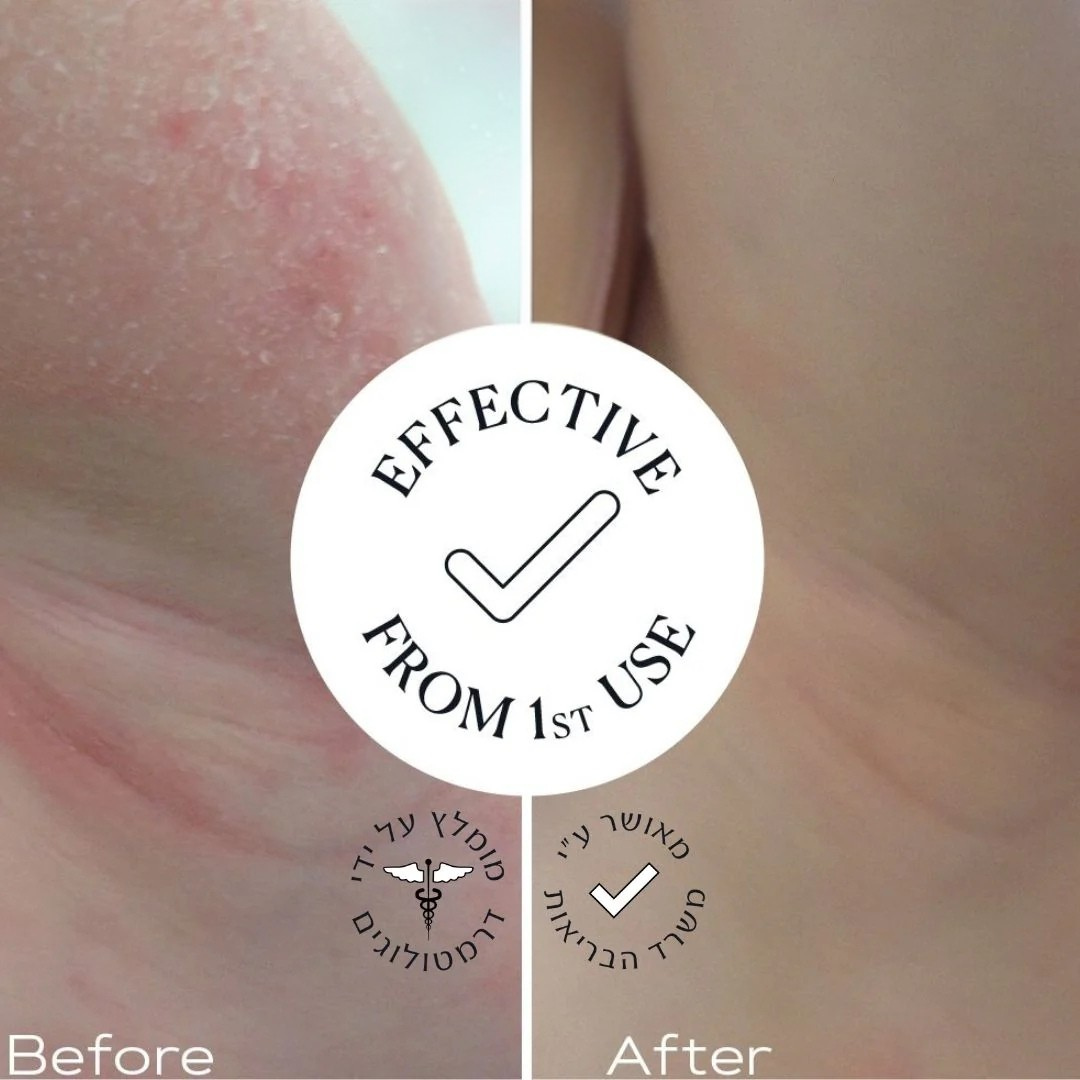 קרם טיפולי להקלה על עור יבש מאוד, אדמומי ומגורה | CALM