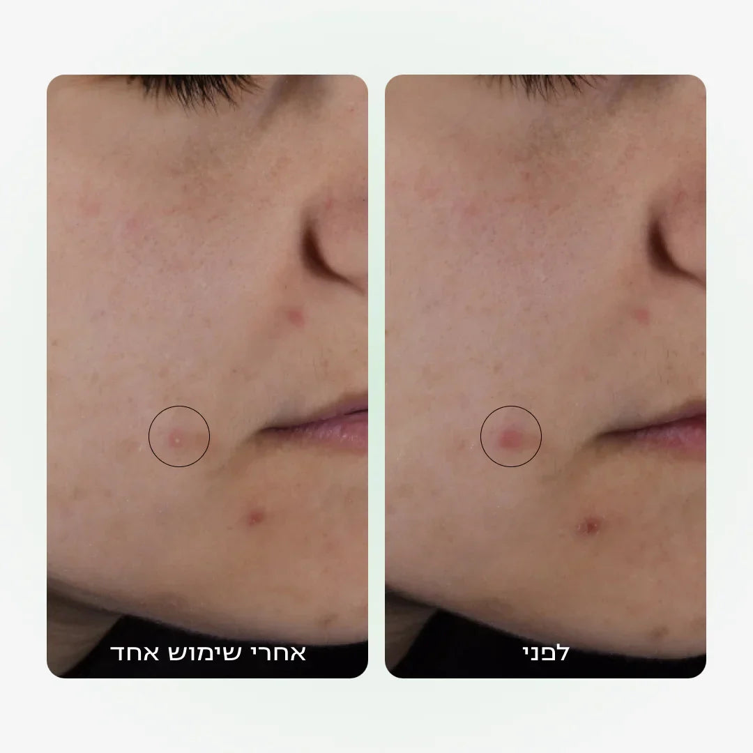 הטיפול החכם של בני הנוער בפצעונים | CLEAR