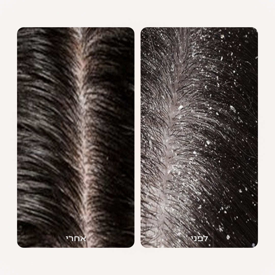 שמפו טיפולי לקשקשים והרגעת קרקפת רגישה | SCALP CONTROL