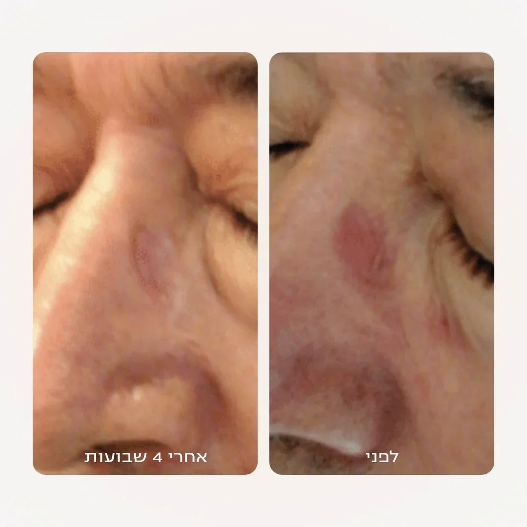 ערכה טיפולית לעור פנים אדמומי ומגורה | SEBO CONTROL (T-Zone)