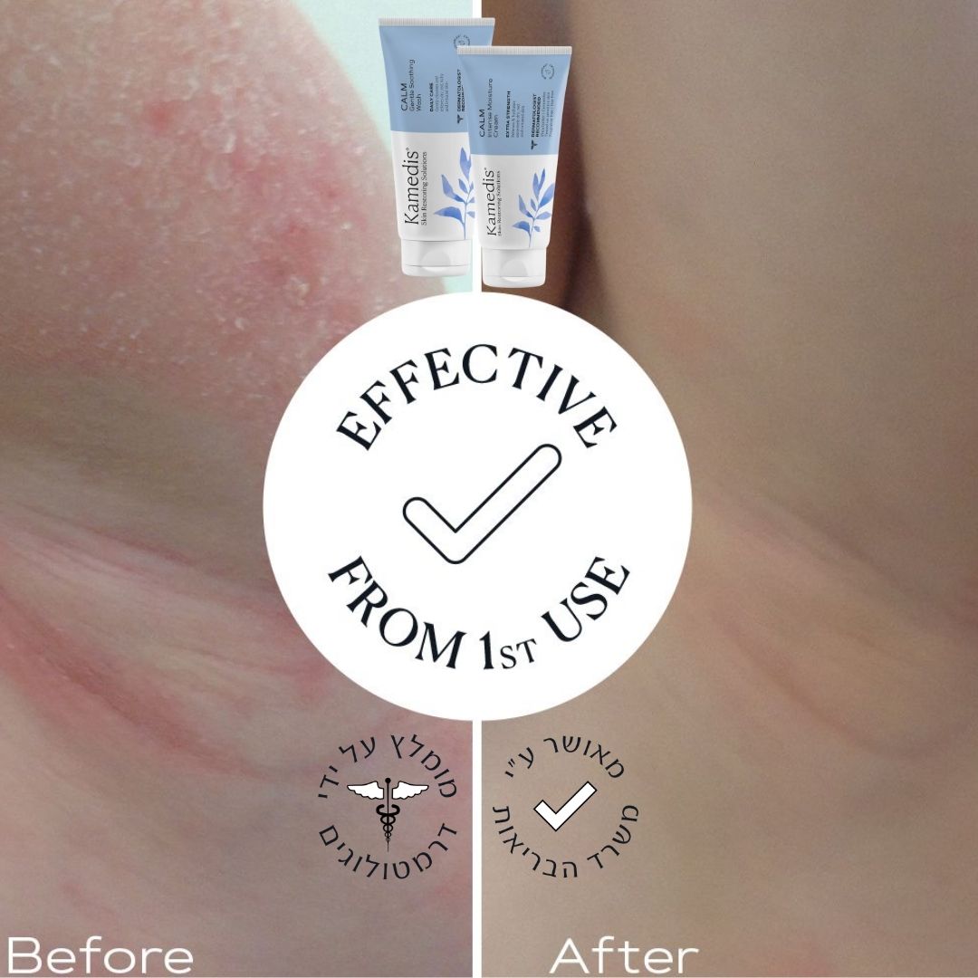 ערכה לשיקום עור אטופי, יבש ומגורה | CALM